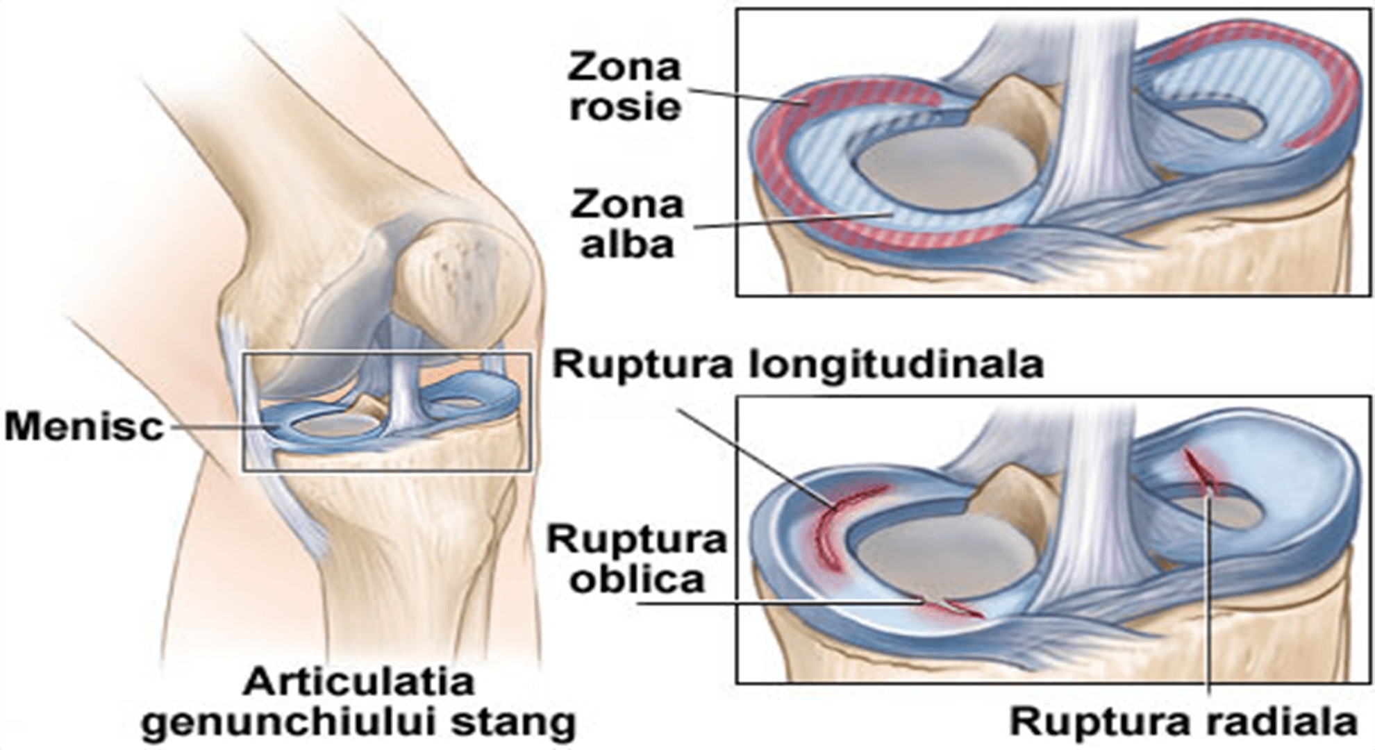 osteoartrita meniscului genunchiului)