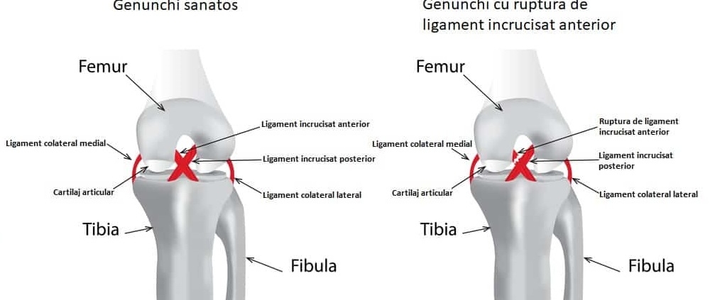 Dispozitive de tratament cu artroză cu ultrasunete deteriorarea ligamentului cruciat anterior al genunchiului