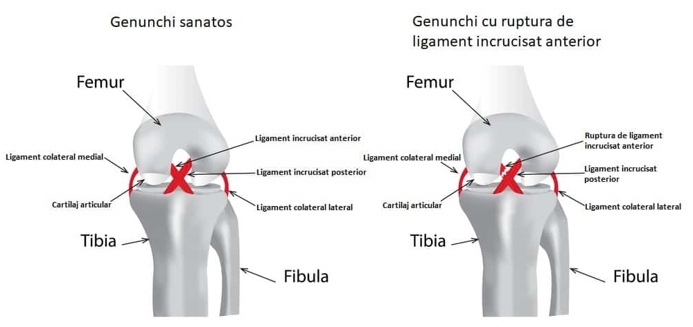 refacere ligamente genunchi ce este edemul trabecular în articulația șoldului