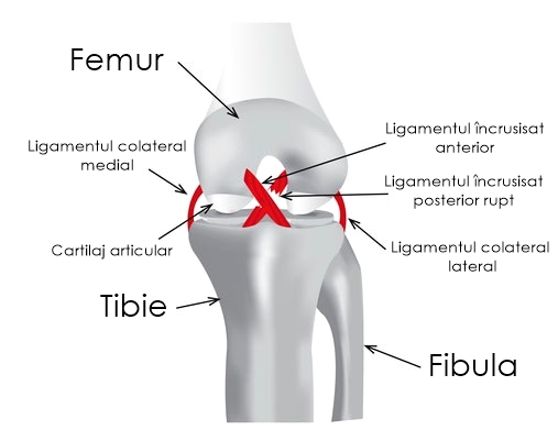 Tratamentul leziunilor ligamentului genunchiului