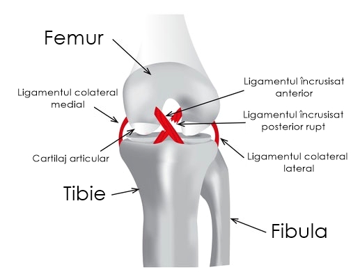 ruperea ligamentului medial al tratamentului articulației genunchiului inflamația articulațiilor degetelor mici ale picioarelor