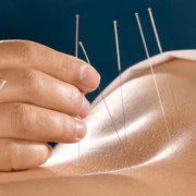 Acupunctura Acupunctură Ac Ace Terapie Ac Acupunctura - ce este, beneficii, puncte, efecte, indicații, contraindicații