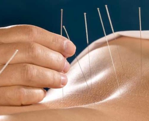 Acupunctura Acupunctură Ac Ace Terapie Ac Acupunctura - ce este, beneficii, puncte, efecte, indicații, contraindicații