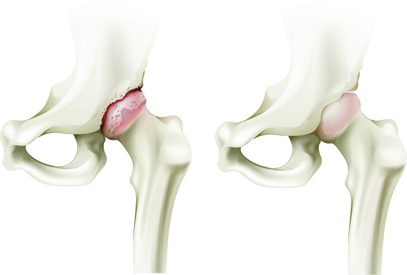 Tratamentul artrozei: metode conservatoare și chirurgicale - Optimove