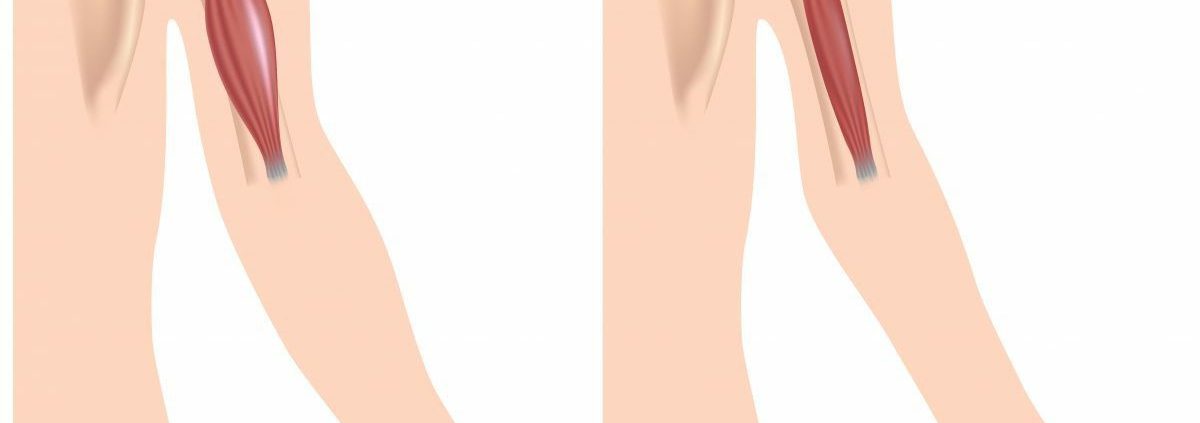 Distrofia musculară - analize, cauze, simptome, recuperare, tratament