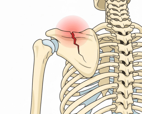 Fractura corpului scapulei - cauze, simptome, tratament