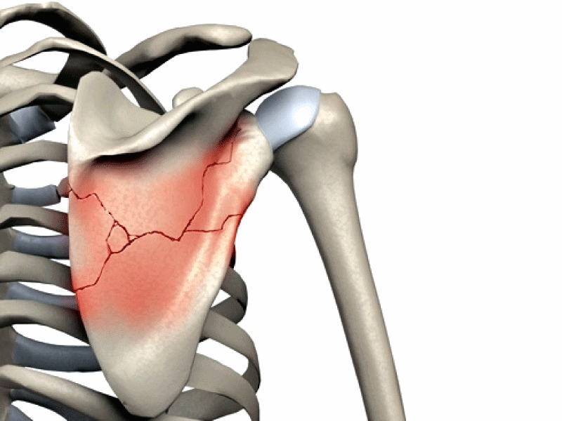 Fractura corpului scapulei cauze, simptome, tratament
