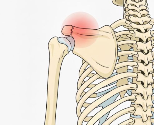 Fractura de acromion - cauze, diagnostic, tratament