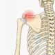 Fractura de acromion - cauze, diagnostic, tratament