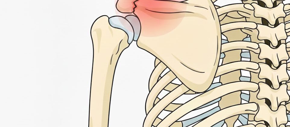 Fractura de acromion - cauze, diagnostic, tratament