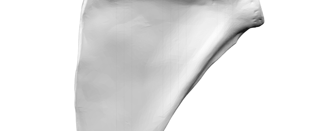 Fractura de proces coracoid