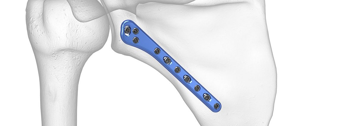 Fractura unghiului extern (glenoidian) al scapulei cauze, evoluție, tratament