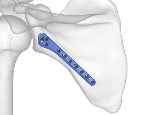 Fractura unghiului extern (glenoidian) al scapulei cauze, evoluție, tratament