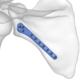 Fractura unghiului extern (glenoidian) al scapulei cauze, evoluție, tratament