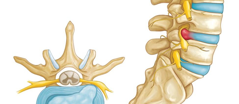 Hernie de disc Hernia de disc - ce este, simptome, clasificare, cauze, diagnostic, tratament, investigații, recuperare, masaj, fizioterapie, kinetoterapie, plasturi, calmante, operatie, medicamente, pastile, bucuresti, tipuri, ceai, recidiva, calmante, unguent