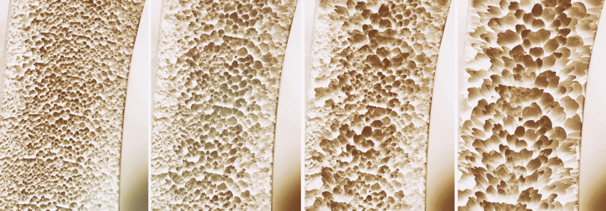 Osteoporoza Osteoporoză Osteopenie Osteoporoza - ce este, cauze, clasificare, diagnostic, evoluție, tratament
