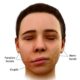 Sindromul Ramsay Hunt (herpes zoster oticus) - ce este, cauze, simptome, diagnostic, tratament