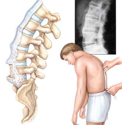 tratamentul coloanei vertebrale bolnave