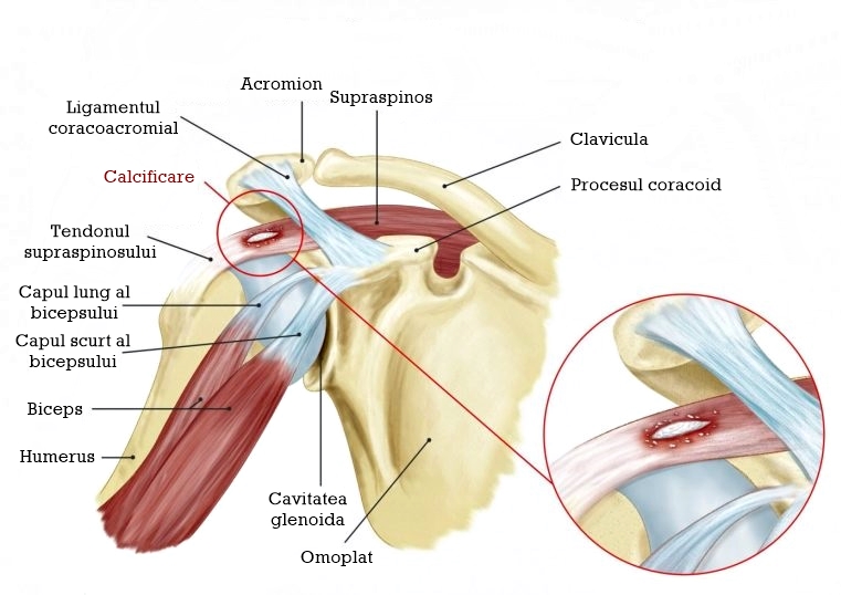 tratamentul articulației umărului drept pastile pentru durerile de spate