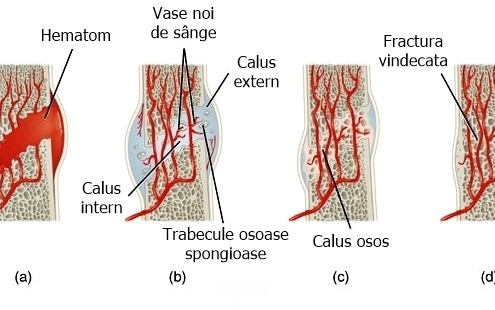 Vindecarea oaselor fracturii fractura calus calusul calusului osos Vindecarea oaselor / fracturii sau formarea calusului