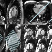 Cardio-RM RMN Cardiac Stres Bucuresti Pret RMN Inima