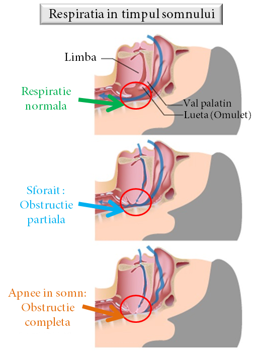 Sleep Apnea Tratament: CPAP, aparate orale, Chirurgie, și Pierdere în Greutate
