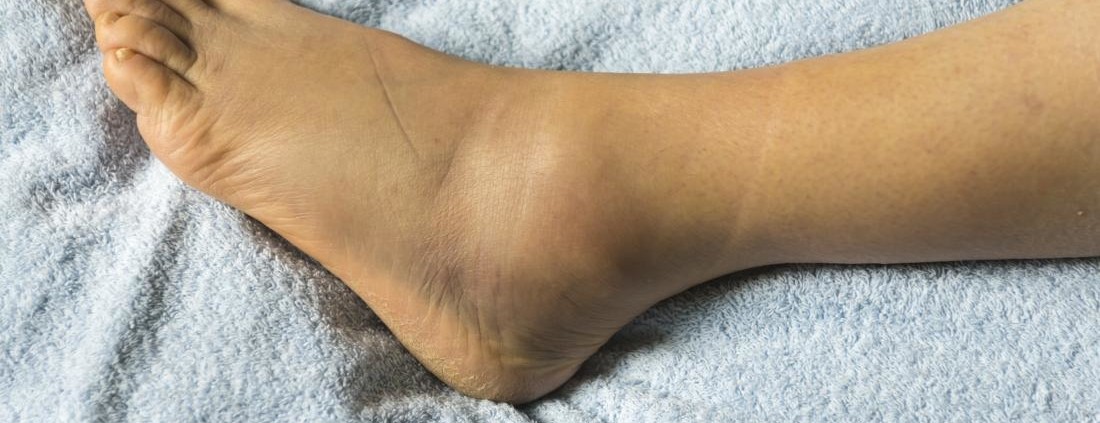 Picioarele umflate: cauze si remedii