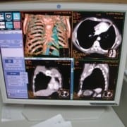C.T. CT Computer Tomograf Tomografie cand este recomandat, ce este, cum se face, cat duraeaza, iradiaza, doare, contraindicatii, indicatii, aplicatii